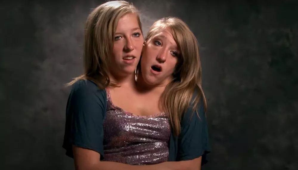 Conjoined Twins Abby And Brittanys Exciting News Travelfiber