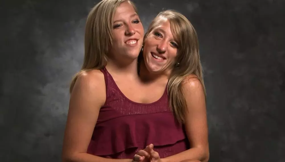Rare Conjoined Twins Abby And Brittany Share Their Exciting News With The World History All Day