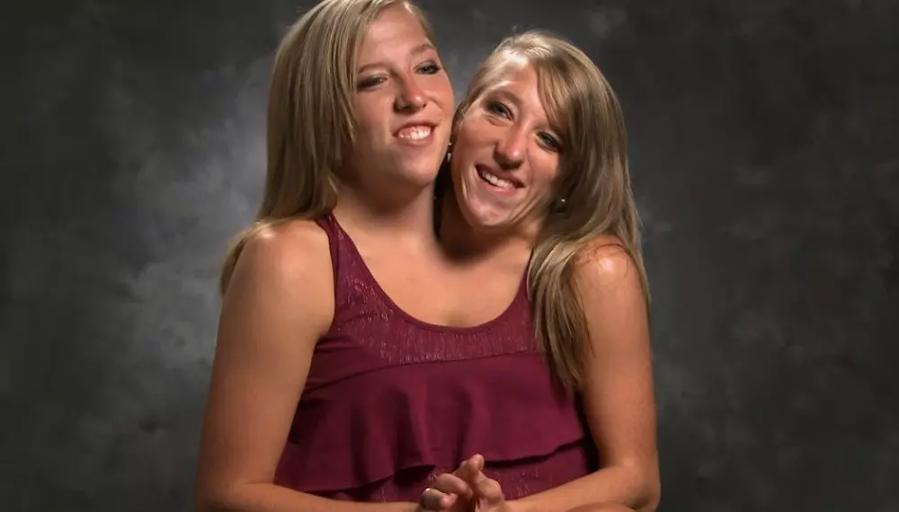 Rare Conjoined Twins Abby And Brittany Share Their Exciting News With