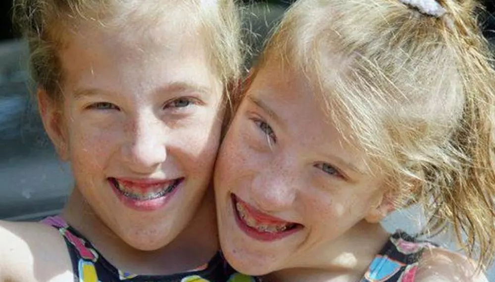 Conjoined Twins Abby and Brittany's Insane Journey Family and Pets
